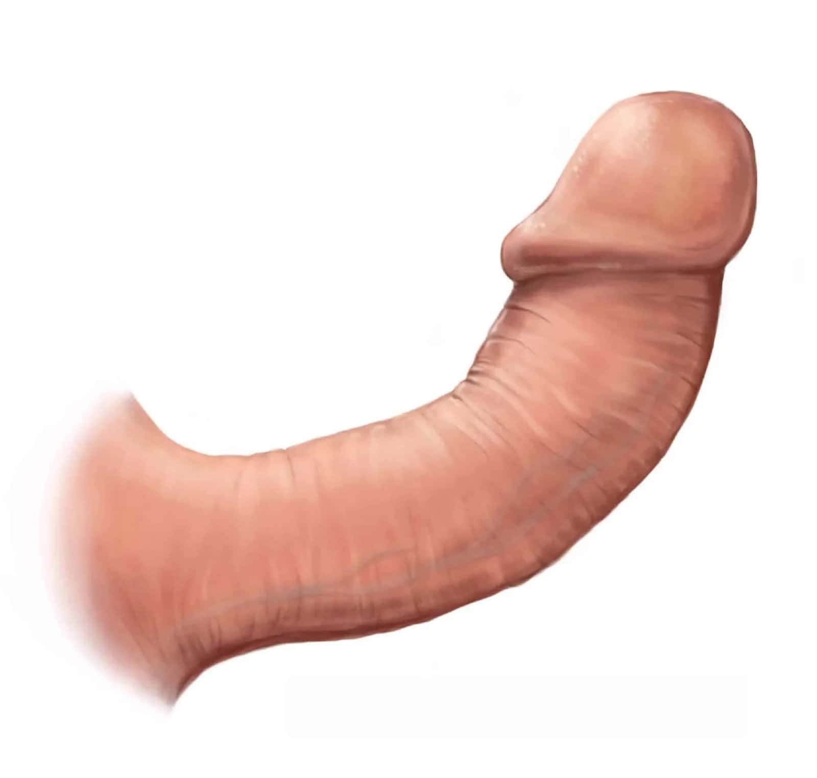 Malattia di La Peyronie