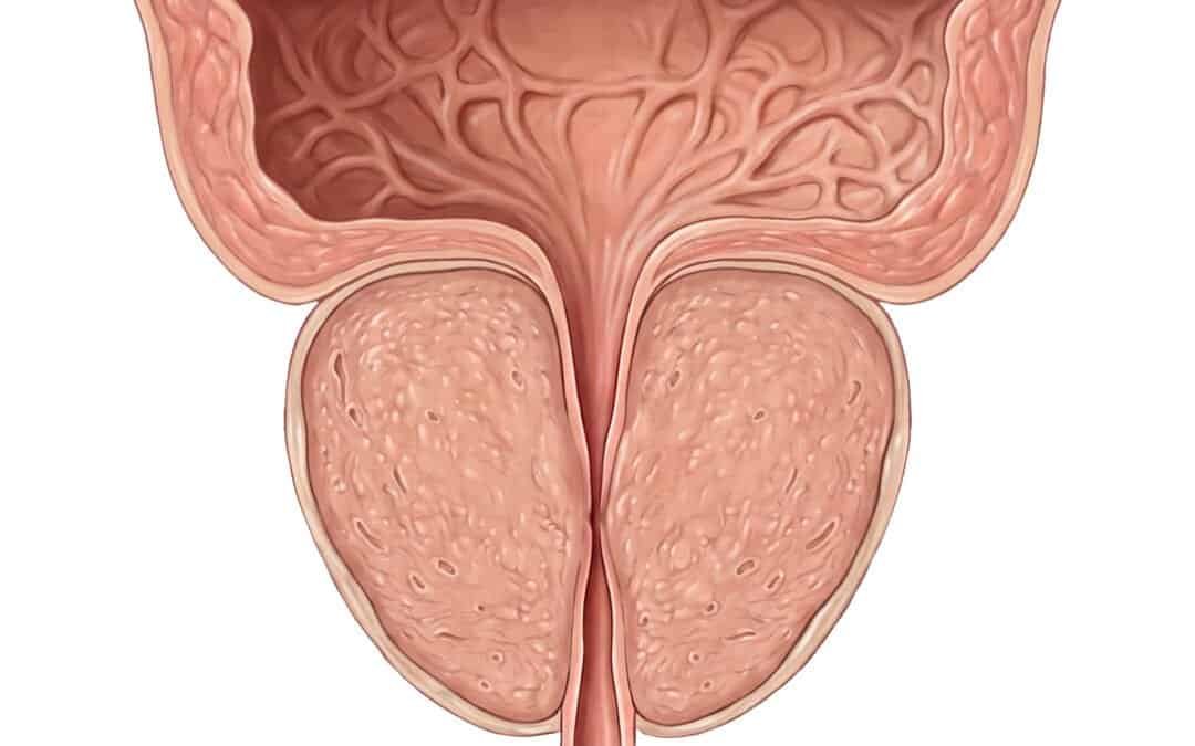 Iperplasia prostatica benigna