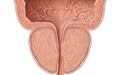 Iperplasia prostatica benigna