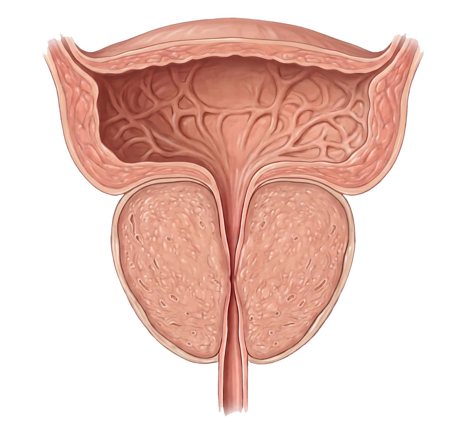 Iperplasia Prostatica Benigna